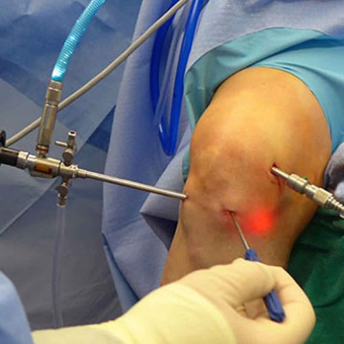 knee-arthroscopy